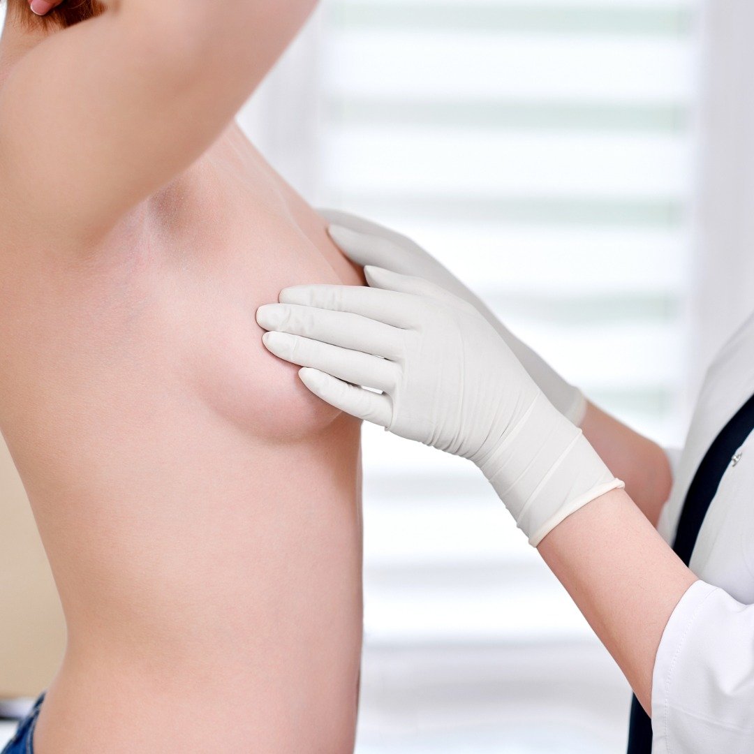 Reducción de pecho: un cambio de vida