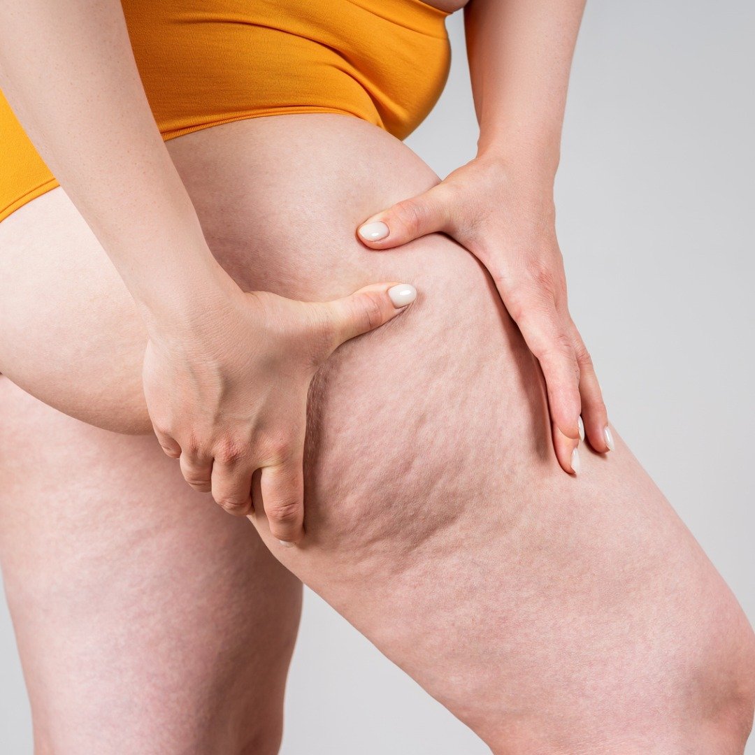 La celulitis y la belleza de tu piel