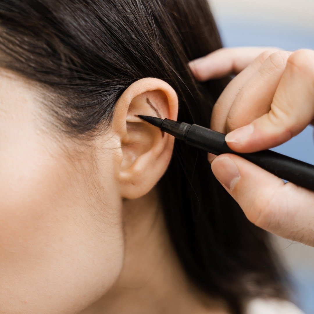 Otoplastia: Cirugía estética de Orejas