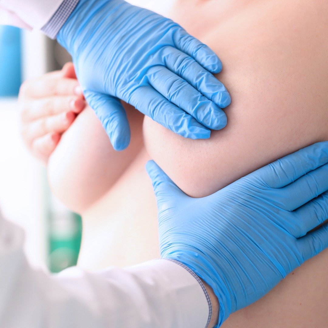 Senos perfectos: ¿Acné en esta zona?